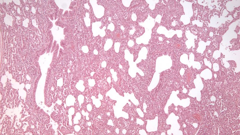 Figura 2: Polmonite interstiziale, caratterizzata da ispessimento dei setti alveolari, in un&#39;infezione da PRRSV.

