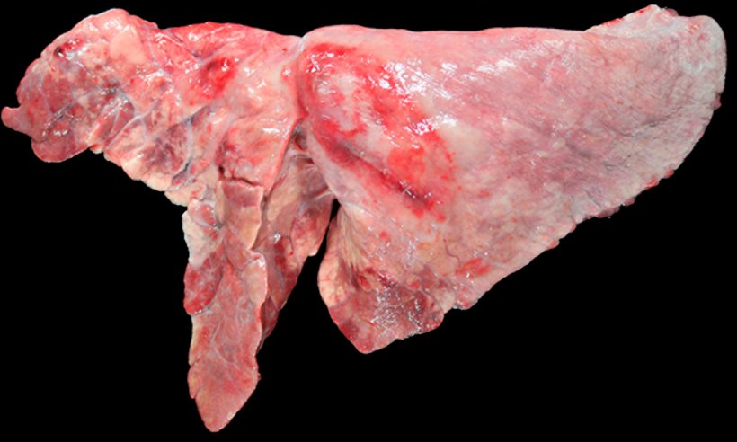 Figura 5: Pulm&oacute;n de un cerdo coinfectado con M. hyopneumoniae y A. pleuropneumoniae. Aree di consolidamento cranio-ventrale di color bruno-rossastre, provocate dalla infezione da&nbsp;M. hyopneumoniae, e una lesione ovale con fibrosi pleurica e zone emorragiche nel lobo diaframmatico,&nbsp;&nbsp;che corrisponderebbe alla cronicit&agrave; di un focolaio di necrosi prodotto da&nbsp;A. pleuropneumoniae.
