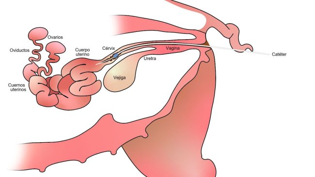 Immagine 1. Nell'inseminazione artificiale post-cerviale, il seme viene depositato nel corpo dell'utero, dopo la cervice.