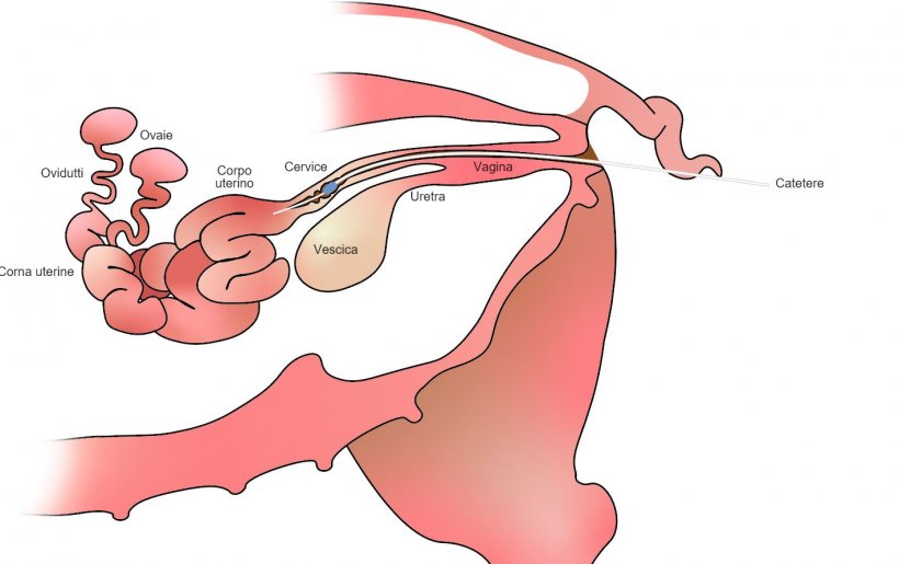 Immagine 1. Nell&#39;inseminazione artificiale post-cerviale, il seme&nbsp;viene depositato nel corpo dell&#39;utero, dopo la cervice.
