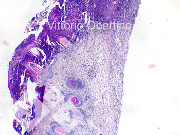 Figura 9. Cute. Focale erosione epiteliale in cui lo strato superficiale &egrave; sostituito da abbondante materiale eosinofilico da amorfo a granulare con detriti cariorettici (necrosi) e abbondanti granulociti neutrofili degenerati e vitali. Multifocalmente l&rsquo;epitelio appare da moderatamente a marcatamente iperplastico con ipercheratosi ortocheratotica da moderata a grave. Si osservano inoltre presenza multifocale di croste. Il derma appare diffusamente e moderatamente fibrotico.
