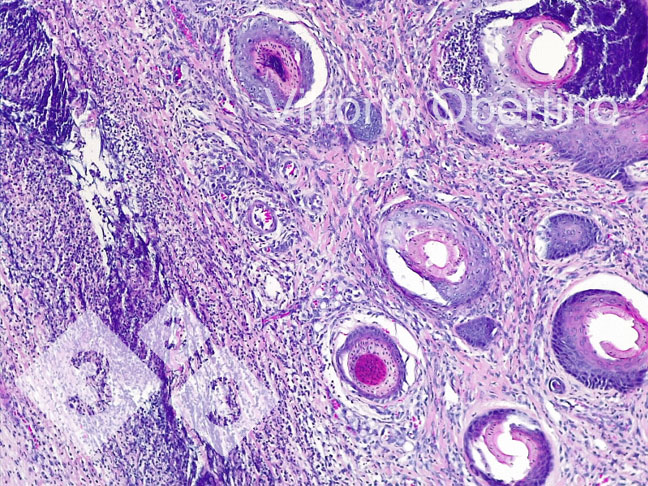 Figura 8: Ombelico. Area dermica localmente estesa costituita da fibroplasia con fibroblasti attivati e numerosi piccoli vasi immaturi (tessuto di granulazione neoformato), multifocalmente infiltrato infiammatorio a prevalenza linfoplasmacellulare; a carico di alcune strutture vascolari si osserva infiltrato infiammatorio granulocitario che circonda la parete vasale e focalmente la infiltra (vasculite leucotaria).
