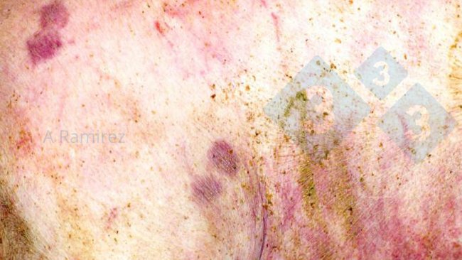 Figura 1. Lesione cutanea a forma di diamante quasi patognomonica.