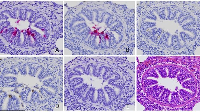 Figura 2. Identificazione di rotavirus A (RVA) nelle cellule epiteliali bronchiolari. Il segnale positivo dell'acido nucleico RVA è stato rilevato mediante ibridazione in situ (ISH) utilizzando una sonda mirata a VP6 (A) e NSP3 (B). Segnali positivi di colorazione immunoistochimica utilizzando anticorpi contro RVA VP6 (C) e dsRNA (D), sebbene più deboli, sono stati rilevati anche nelle sezioni seriali ottenute dallo stesso caso. Nessun segnale è stato rilevato da ISH utilizzando una sonda mirata al rotavirus B (E) (18). È stata eseguita una sezione seriale con colorazione di routine con ematossilina ed eosina (F). Le immagini sono state scattate con un ingrandimento di 400x.