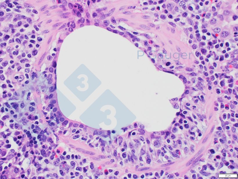 Figura 4: Istopatologia polmonare che mostra l&#39;assottigliamento dell&#39;epitelio bronchiolare, che &egrave; un esempio di necrosi. (Fonte foto: Phil Gauger ISUVDL)
​
