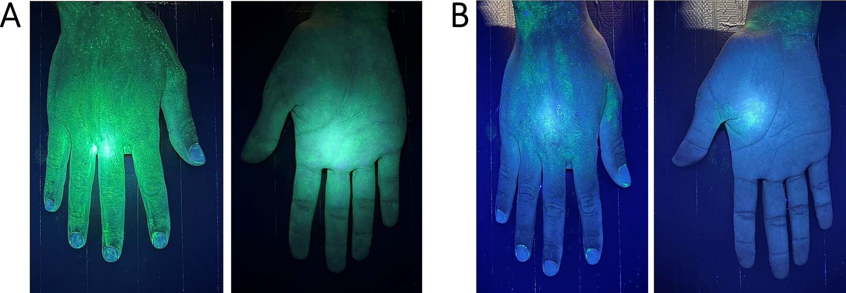 Figura 1. Esame della mano sotto luce UV in una scatola: (A)—vista pre-pulizia (dopo l'applicazione del gel UV la luce fluorescente segna l'intera mano) e (B)—vista post-pulizia (punti fluorescenti segnano le aree che non sono state pulite correttamente).