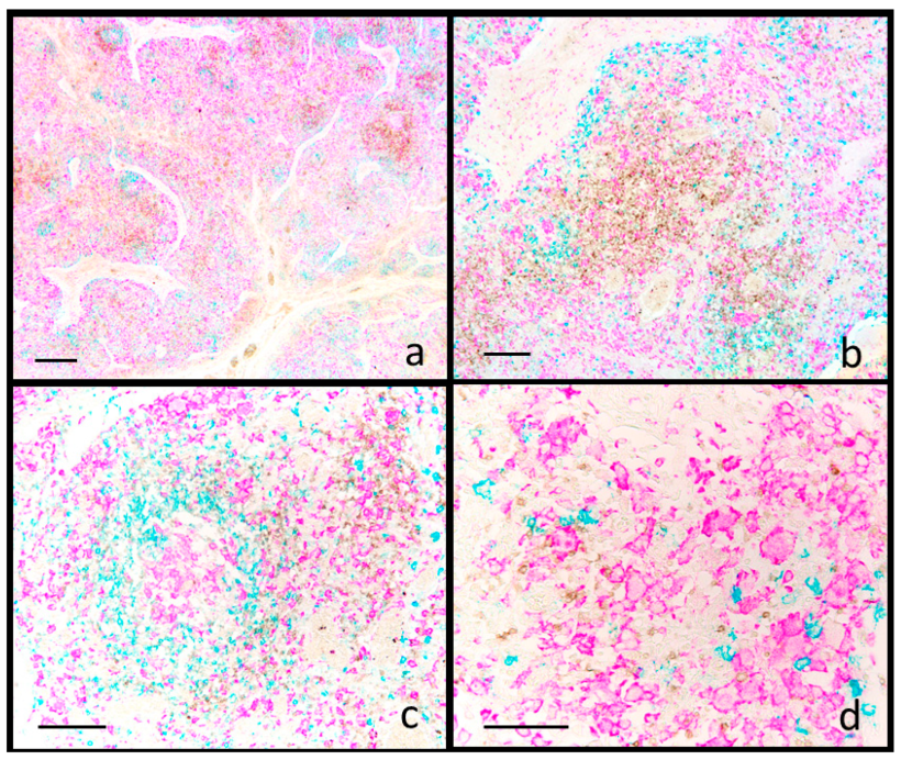 Suino. Linfonodo inguinale. Infezione sistemica da PCV2. Immunoistochimica multiplex per CD3 (marrone), CD20 (blu) e IBA1 (fucsia). (a) I follicoli radi e sbiaditi mostrano una riduzione dei linfociti CD20+ (b) e la presenza di cellule epitelioidi follicolari IBA1+ (c). Nell'area interfollicolare, i linfociti CD3+ sono fortemente ridotti (b, c), mentre i macrofagi IBA1+ sono aumentati (b). La colorazione per IBA1 &egrave; rilevabile anche nelle cellule epitelioidi e giganti (d). Barra della scala: (a) 800 &mu;m; (b) 200 &mu;m; (c) 150 &mu;m; (d) 100 &mu;m.Animals 2025, 15, 1682. https://doi.org/10.3390/ani15121682