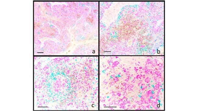 Suino. Linfonodo inguinale. Infezione sistemica da PCV2. Immunoistochimica multiplex per CD3 (marrone), CD20 (blu) e IBA1 (fucsia). (a) I follicoli radi e sbiaditi mostrano una riduzione dei linfociti CD20+ (b) e la presenza di cellule epitelioidi follicolari IBA1+ (c). Nell'area interfollicolare, i linfociti CD3+ sono fortemente ridotti (b, c), mentre i macrofagi IBA1+ sono aumentati (b). La colorazione per IBA1 è rilevabile anche nelle cellule epitelioidi e giganti (d). Barra della scala: (a) 800 μm; (b) 200 μm; (c) 150 μm; (d) 100 μm.Animals 2025, 15, 1682. https://doi.org/10.3390/ani15121682