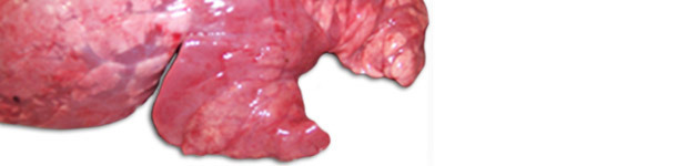 pneumonia