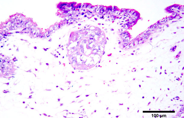 Necrosi coagulativa in trofoblasti. Ematossilina-Eosina. Tinción hematoxilina-eosina. 