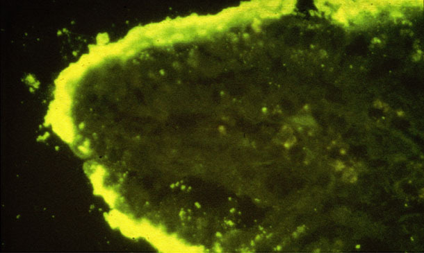 Dense colonie di E coli adese ad un villo intestinale (IFA)