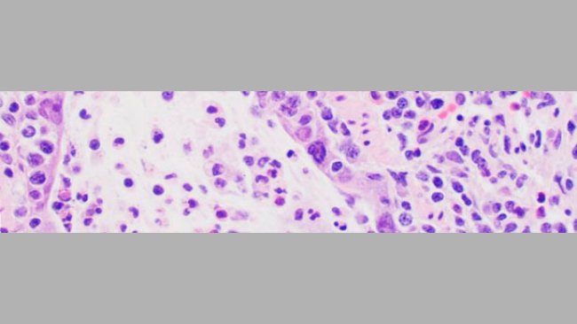 Lesioni microscopiche compatibili con l'infezione influenzale, necrosi dell'epitelio bronchiolare dove il virus si replica