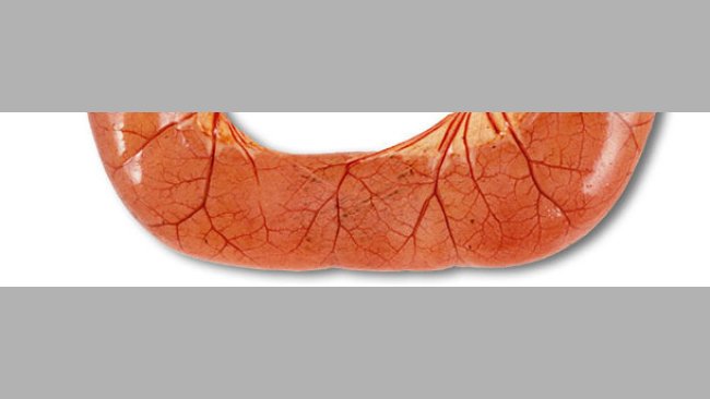 La necropsia de casos de diarrea por ETEC suele mostrar asas del intestino delgado dilatadas, finas y congestionadas, llenas de diarrea acuosa de color amarillo.