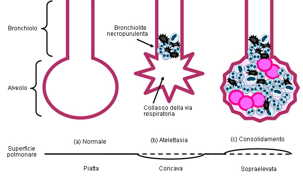 Bronchioli