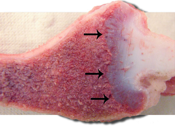 Giunzione costocondrale piatta con crescita irregolare della cartilagine