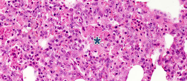 Resti necrotici intralveolari e accumulo di cellule infiammatorie (asterisco) nel tessuto polmonare a 10 gg PI con isolato PRRSV tipo 1 subtipo 1