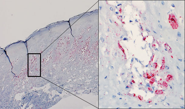 Biopsia cutanea di una vescicola di un suino infetto