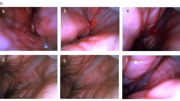 Inseminazione post-cervicale vista dall'inerno dell'utero