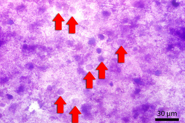 Frotis fecal teñido con Diff-Quick. Las flechas rojas señalan los Blastocystis