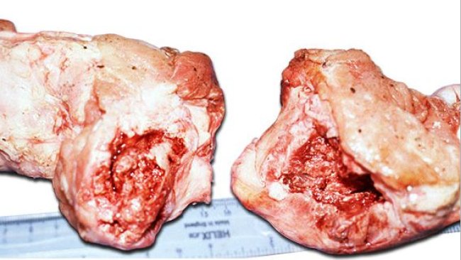 Cabeza del fémur completamente fracturada por la epífisis o debajo de ella mostrando hinchazón alrededor de la fractura debido a periostitis