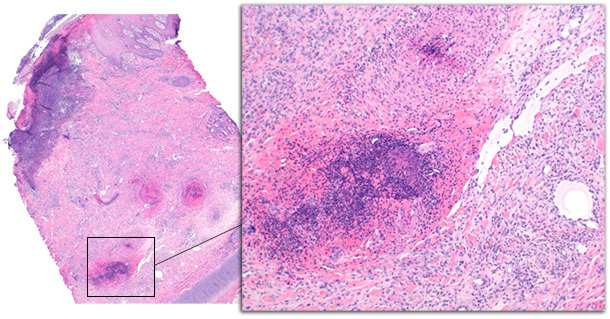 Biopsia de la punta de la oreja de un cerdo con afectación crónica. Los cambios epidérmicos incluyen la ulceración con inflamación subyaciente, formación de una costra serocelular y acantosis en la epidermis. La dermis profunda está expandida por tejido de granulación y hemorragias. Los vasos de la dermis profunda están afectados por trombosis y vasculitis.