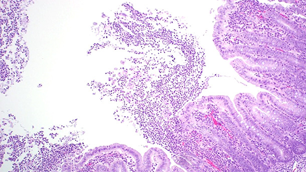 Colite ulcerativa fibrinopurulenta multifocale o localmente diffusa