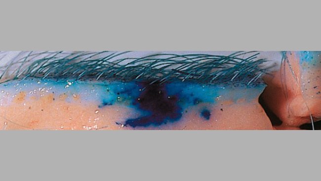 La tecnologia senza ago migliora la dispersione dei vaccini nei tessuti.