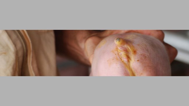 Diarrea neonatall causata da E. Coli (Cortesia Dr Hector Patullo)