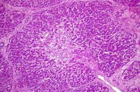 Necrosi centrolobullare dell'epatocito e destruzione massiva della struttura epatica con infiammazione mononucleara e megalocit