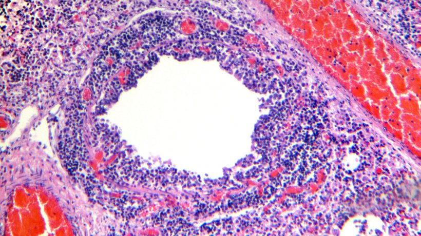 Figura 4. Bronchiolo che evidenzia necrosi e desquamazione cellulare, con marcata infiltrazione linfocitica sulla lamina propria e submucosa.
