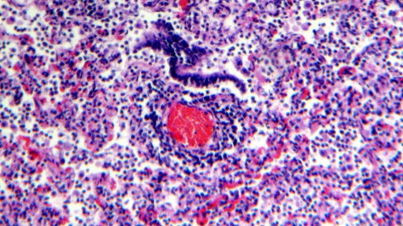 Figura 5. Infiltrato linfocitario perivascolare
