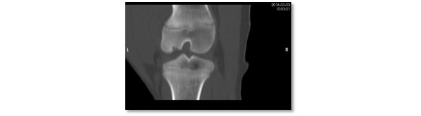 Vista della stessa lesione mediante tomografia computerizzata. Grave lesione da osteocondrosi con carenza di ossificazione nella regione subarticolare del condilo femorale laterale.
