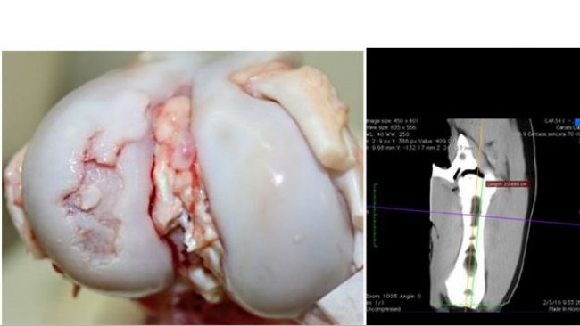 Visione macroscopica dell'articolazione del ginocchio con una grave lesione da osteocondrosi nel condilo laterale del femore.