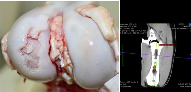 Visione macroscopica dellarticolazione del ginocchio con una grave lesione da osteocondrosi nel condilo laterale del femore